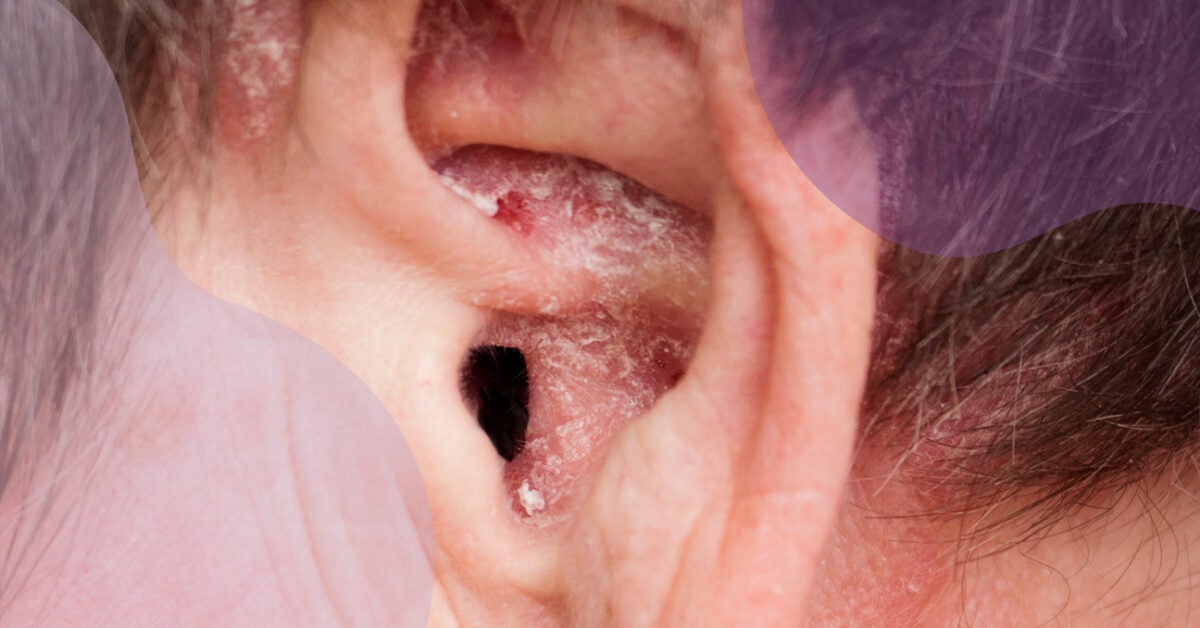 Managing Psoriasis in Your Ears