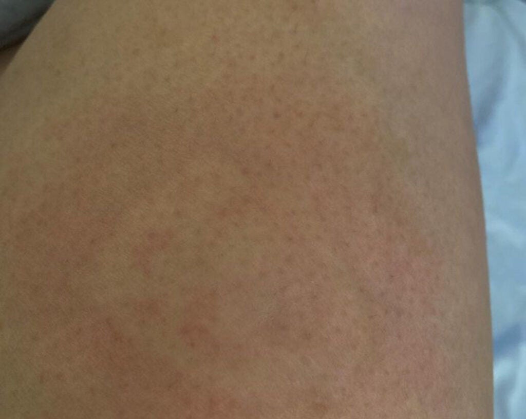 Rheumatoid Arthritis Rashes and Skin Changes